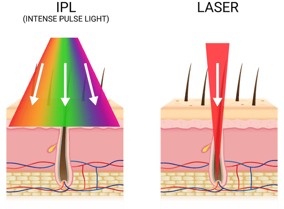 https://www.tricellbio.com/wp-content/uploads/2020/06/ipl-vs-lasr.png